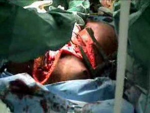 Gunshot wound to the chest