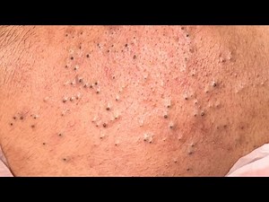 Blackhead Extraction Close-UP