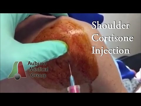 Shoulder Steroid Injection Posterior | Auburn Medical Group