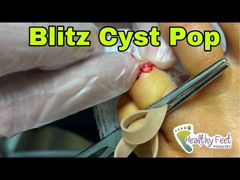 Popping a Ganglion Cyst