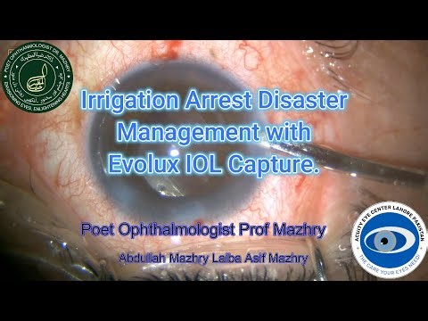 Irrigation Arrest & PCR Management: Evolux IOL Optic Capture | Lahore Ophthalmo 2025