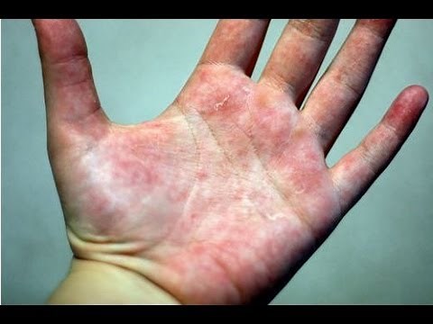 DermTV - How to Treat Eczema [DermTV.com Epi #178]