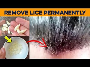 How to Get Rid of Lice Permanently in 1 Hour - Home Remedies to Get Rid of Lice Eggs in Hair