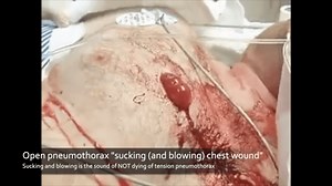 A sucking (and blowing) chest wound is the sound of not dying