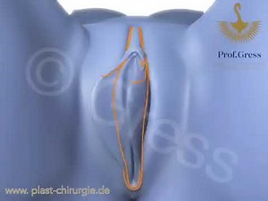 Composite Reduction Labiaplasty: Labia + Clitoral Hood Reduction, correction of clitoral protrusion