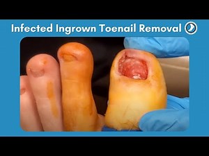 Removal of a Severely Infected Toenail