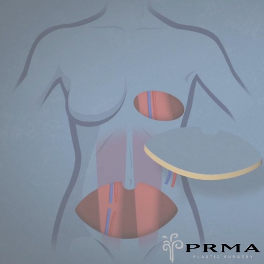 If you're considering breast reconstruction after mastectomy, the DIEP flap might be the perfect solution for you. 🌿 What is the DIEP flap? DIEP stands for Deep Inferior Epigastric Perforator, and it's a revolutionary approach that utilizes your own abdominal skin and fat to recreate a natural and soft breast. Unlike traditional methods like the TRAM flap, the DIEP technique preserves all your abdominal muscles, ensuring minimal discomfort and a faster recovery. ✨ The Benefits: 💕 Natural Resul