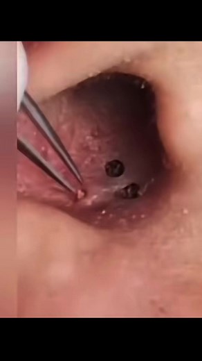 Blackhead in ear #pimplepopper #blackhead #extraction #earwaxing #cyst