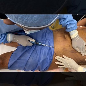 Male liposuction is liposuction that specifically targets the areas in which men most commonly store excess fat – namely, the “spare tire” area, the flanks, “love handles,” “beer belly,” “muffin top.” In other words, the area of the mid-torso. While women have a tendency to gain weight in the extended region from their ribs to their knees, men have a more isolated area in which they gain fat. #maleplasticsurgery #malebeforeandafter #maleliposuction #abdominaletching #marcacionesabdominales | Man