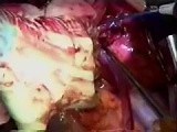 Rapid Sequence Heart and Lung Transplant • Video • MEDtube.net