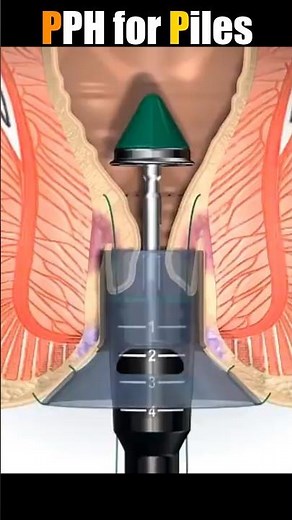 3D Animation of the PPH Procedure for Fourth-Stage Hemorrhoids #short