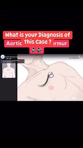 38K views · 341 reactions | A 75-year-old male presents with exertional dyspnea, chest pain, and syncope. Examination reveals a delayed carotid upstroke and a crescendo-decrescendo systolic murmur at the right upper sternal border, radiating to the carotids. | Medical Talks | Facebook