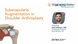 TAPESTRY for Subscapularis Repair