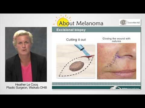 How is melanoma removed?