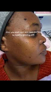 Keep your skin glowing and hydrated with Lamelle Lactic Acid peel as the temperatures drop! ❄️✨ This treatment is all about deep hydration, leaving your skin rejuvenated and glowing—just in time for the cooler weather. 🌸 Watch the magic unfold as we refresh and nourish your skin for that radiant, dewy finish! 💧Book your session today and enter the new season with a fresh glow! #MesoFacial #WinterGlow #HydratedSkin #SkincareRejuvenation #glowingskin #fyp #lacticacid #HealthySkin #fypviralシ #exp