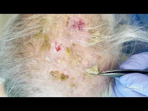 Debulking Lesions on the Scalp (Erosive Pustulosis of the Scalp) | CONTOUR DERMATOLOGY