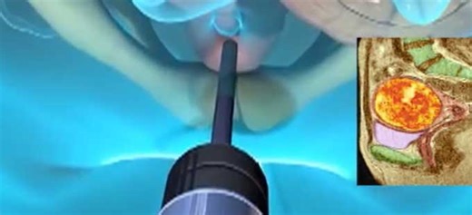 Laparoscopy: లాప్రోస్కోపీతో ఆపరేషన్‌ చాలా సులువు..  ఎలాగో తెలుసుకోండి