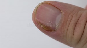 Close Up of Nail Fungus Infection on the Thumb Finger Stock Footage - Video of damage, medicine: 131619836