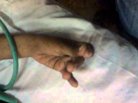 Trousseau's sign 1.mp4