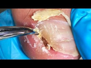 Excessive Ingrown Nail With Dead Skin Stuck To It, Trim Carefully!【Crazy pedicure room】