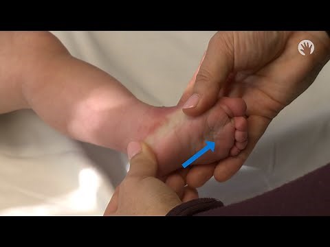 Clubfoot Stretches | Inner Arch Stretch | Module 1