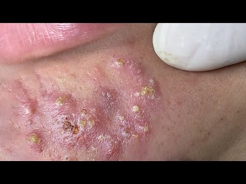 Suri Job #663: Awesome Blackheads Extraction