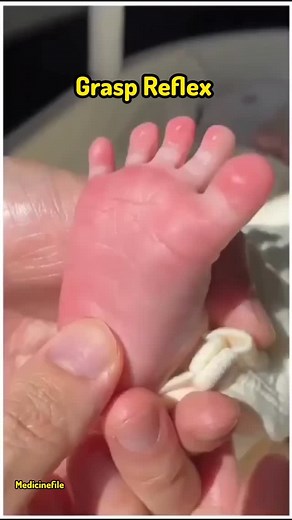The grasp reflex is a primitive reflex seen in newborns and young infants. When you place a finger or object in a baby's palm, they will automatically close their fingers around it. This reflex is present from birth and usually fades by around 3 to 6 months of age as the baby gains more voluntary control over hand movements. Types of Grasp Reflex: Palmar Grasp Reflex – Seen in the hands; the baby tightly grips anything placed in the palm. Plantar Grasp Reflex – Seen in the feet; the baby curls t