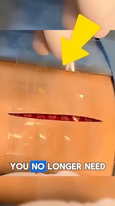 You’ll Never Have to Get Stitches Again With the Clozex Wound Closure Strip, you may never need stitches again. This easy-to-use strip quickly closes cuts and wounds without needles or pain. It gently pulls the skin together, promoting fast healing while reducing scarring. Perfect for minor injuries, Clozex offers a safe, convenient, and effective alternative to traditional stitches. Credit : @clozexmedicalinc.255 /yt #usa #usareels #Technology #medical #safety #tranding #woundclosure | Viral Me