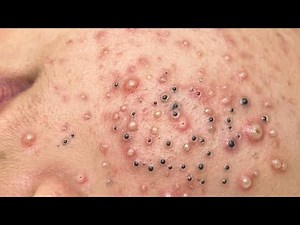 Forbidden Relief: Extreme 2026 Blackhead Extraction (Sac Dep Spa Style Today)