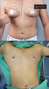 Gynecomastia Surgery