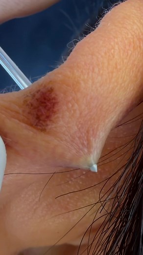 Tem piercing que é bonito… e tem piercing que IMPÕE presença. 😮‍💨🔥 Esse hélix ficou simplesmente perfeito. Perfuração alinhada, joia adequada no visual e aquela estética que chama atenção de longe. 👀 Quem curte personalidade no estilo sabe: um piercing bem feito muda completamente a vibe da orelha. Coragem você já tem… falta só marcar o horário. 😏 Me segue pra ver mais perfurações insanas e chama no direct pra garantir a sua. #piercinghelix #helixpiercing #piercingbrasil #bodypiercing #orel