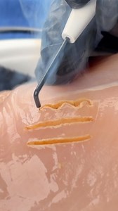 5.2K views · 19 reactions | Domed Electrosurgery in Action ⚡ Efficient, Accurate, Smooth tissue handling Experience better control and faster healing in every procedure. #Dentalkart #Electrosurgery #DentalReels #Waldent #PrecisionDentistry #DentalTools | DentalKart | Facebook