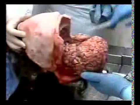 Autopsy