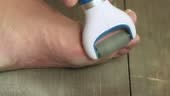 An electric grater cleans the foot. Keratinization and thickening of...