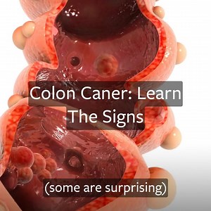 212K views · 275 reactions | Colon cancer has been called the "silent killer" and older adults are at the highest risk. Research colon cancer signs and symptoms here. | Nation.com | Facebook