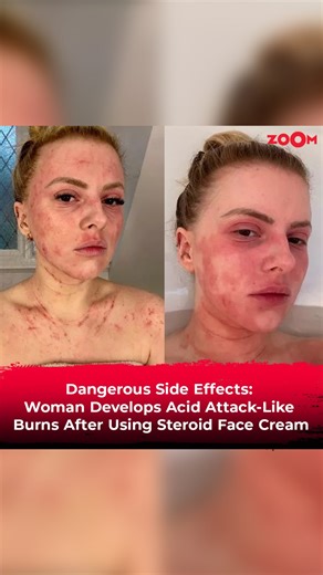 Join us in understanding the dangers of steroid creams 😱 This video details a woman's experience with severe burns. Stay informed for healthier choices. #zoomtv #healthcare #healthylife #healthylifestyle #healthcaretips #skincare #skincaretips #trending #news #fyp | Zoom TV
