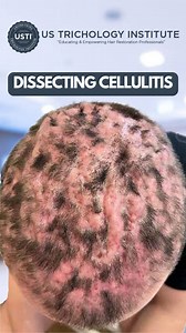 Dissecting Cellulitis, The Intricacies of Skin Inflammation . . . #hairstyle #shampoo #hairloss #conditioner #hairtransplant #hairtransplantation #hair #trichologist #trichology #alopecia | United States Trichology Institute | Facebook