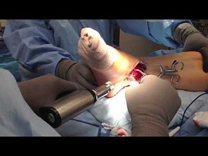 ORIF Bimalleolar Ankle Fracture Surgery