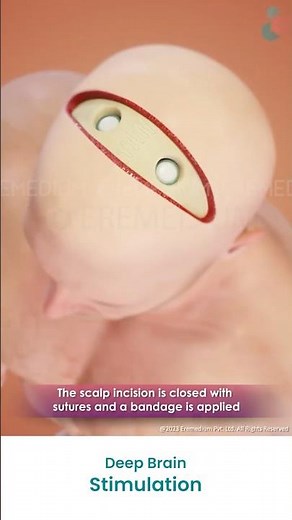 What is Deep Brain Stimulation (DBS)? ↪ 3D Medical Animations #(DBS) #DeepBrainStimulation #Shorts