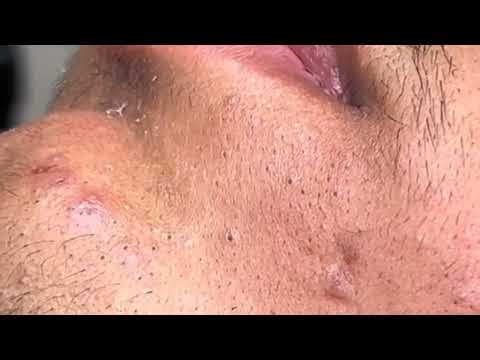 Yummy comedonal acne _ how to get rid of acnes on the face _ acne pimple remove blackheads