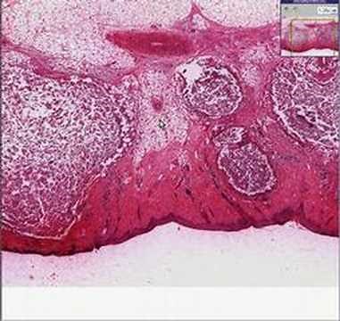 Histopathology Skin -- Furuncle (abscess)
