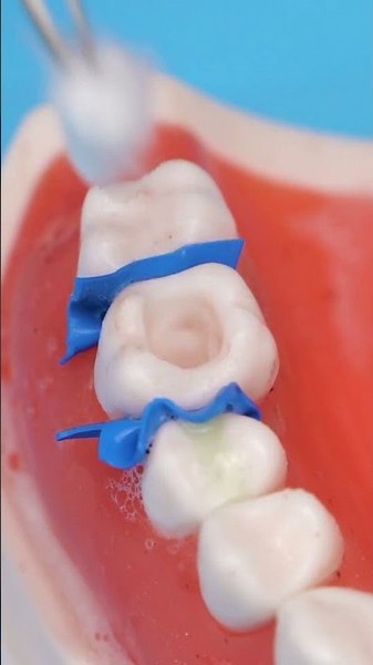 Behind the Scenes of Cavity Removal: An Expert's Perspective! 🦷✨