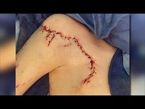 9-Year-Old Who Survived Shark Attack Left With 120 Stitches