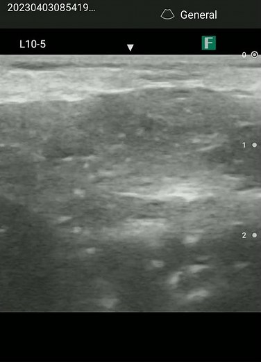 腹部超音波（エコー）検査 幽門部