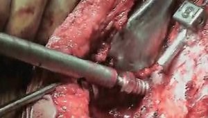 Posterior Vertebral Column Resection