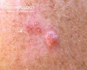 Deadly skin cancer can appear anywhere on the body, even where the sun doesn’t shine - WTOP News