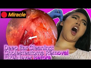 🔴 Shocking Cholesteatoma Removal: Watch This Life-Changing Procedure!