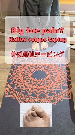 Hallux valgus taping 禮(外反母趾テーピング) Hallux valgus is a very common foot problem among people. It can be caused by weak foot intrinsics, poor foot control, and poor footwear. By adjusting the big toe position, foot intrinsics may work better and pain may be reduced. Try it if you have big toe pain!! ⛑️ #hallux #valgus #taping | FuncPhysio Physical therapy P.C. | Facebook