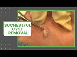 SuCHESTful Cyst Removal | Dr. Derm