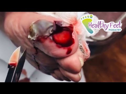THE BEST POPPING, PUS, OOZING AND SPEWING VIDEOS YOU MISSED!